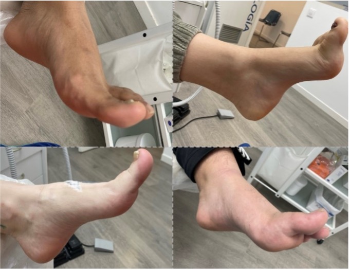 Ejemplos de hallux extensus