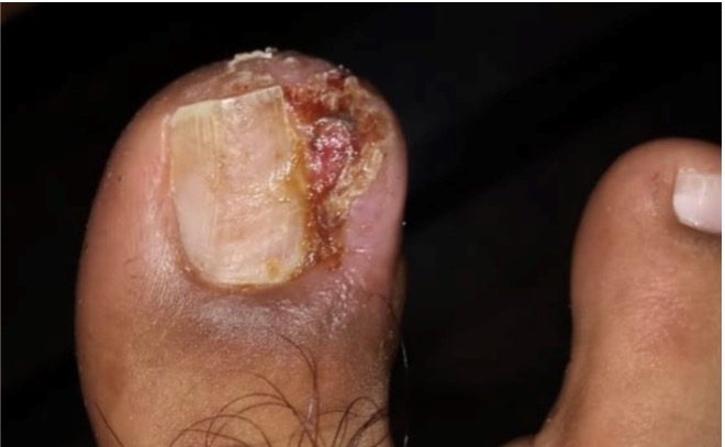 uña arrancada de un lateral con infección posterior 