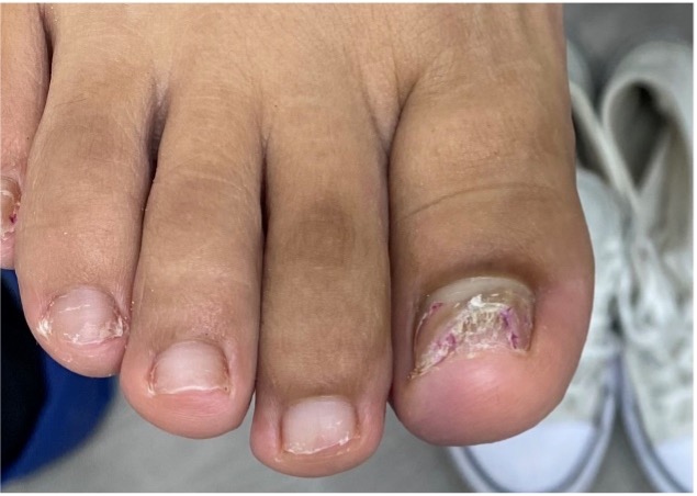 uña dañada por zapatilla de punta de goma