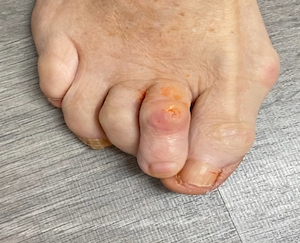 Copia-hallux-valgus-juanete