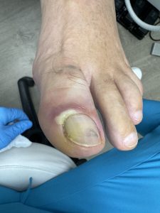 panadizo